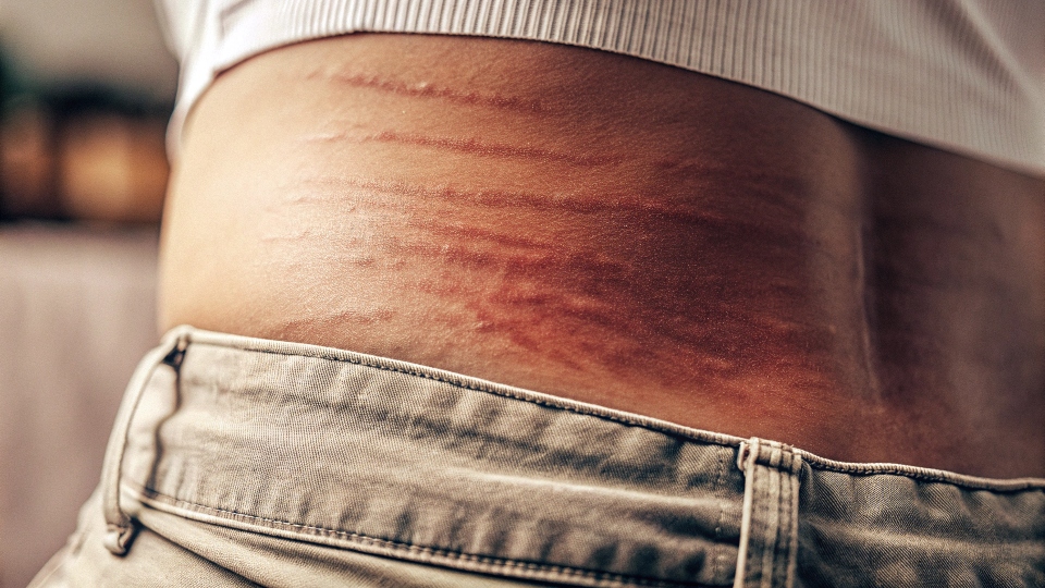 Symptoms of Tight Jeans on Skin A close-up of the red indentation marks left on someone's waist after taking off tight jeans