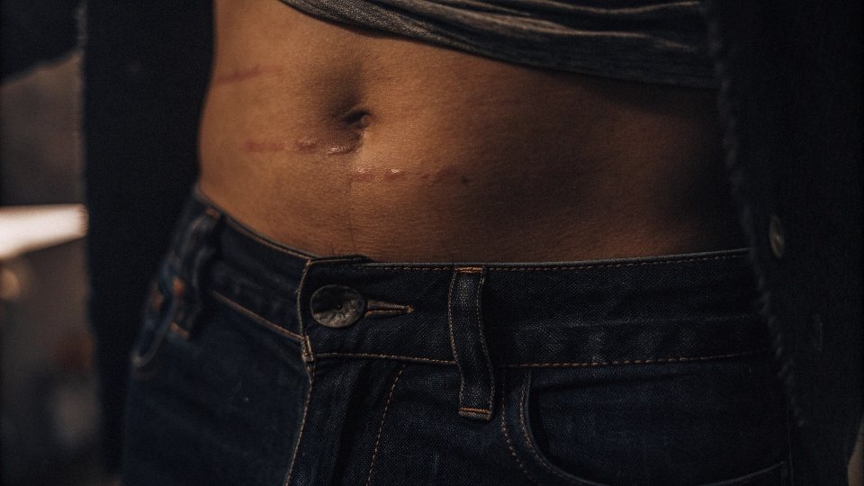 Symptoms of Tight Jeans on Skin A close-up of the red indentation marks left on someone's waist after taking off tight clothing
